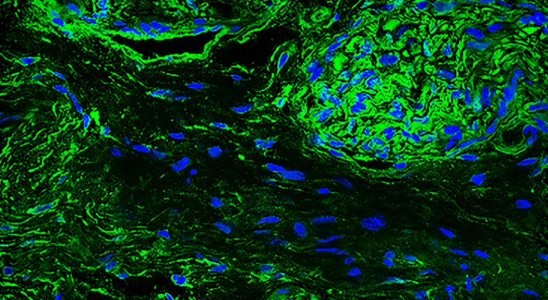 Bioengineered Model of the Bone Marrow to Study and Combat Cancer